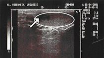 Ultraschallbild des Hodens bei Hodentumor. Innerhalb des Hodens (oval) läßt sich eine dunkle Raumforderung (Pfeil) nachweisen.