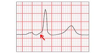 EKG mit Delta-Welle (Pfeil)