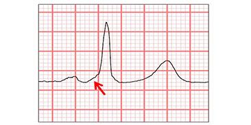 EKG mit Delta-Welle (Pfeil)