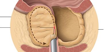 eau©2017patients.uroweb eau©2017patients.uroweb