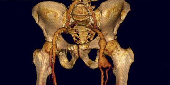 3D-Rekonstruktion aus einer Kernspin Angiographie mit Darstellung der Becken-, Leisten- und Oberschenkelarterien sowie eines Aneurysmas der linken Leistenschlagader.