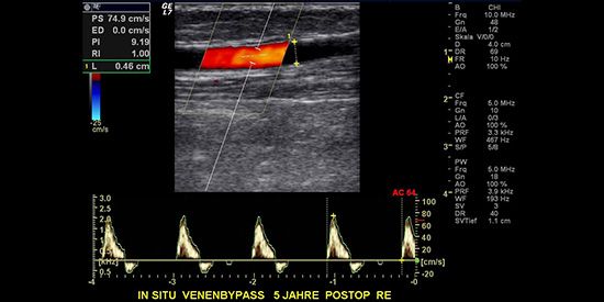 Farbcodierte Doppler-Ultraschall Darstellung (Duplex) eines fünf Jahre zuvor angelegten Bypasses am Oberschenkel aus körpereigener Vene.