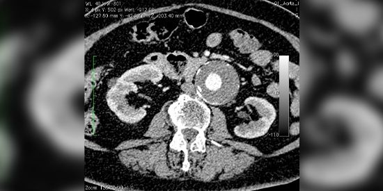 CT mit Kontrastmittel: Darstellung eines Aortenaneurysmas im Querschnitt in Höhe der Nieren. In der Mitte sieht man das (weiße) Blut, die Schicht außen besteht aus festem Blutgerinnsel.