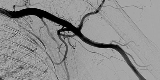 Angiographie (DSA) einer gesunden Schulter- und Oberarmarterie links.