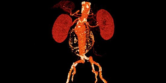 3D-Rekonstruktion eines Aortenaneurysmas aus CT-Bildern. Man sieht die Kalkschale der Aneurysmawand, die Verkalkungen der Beckenarterien sowie das durch das Aneurysma strömende Blut. Das Aneurysma weist einen Randsaum aus Blutgerinnsel auf.