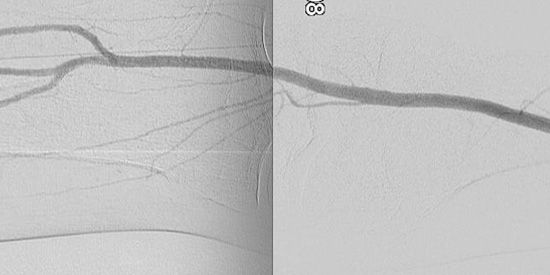 Angiographie in DSA Technik mit normalem Kontrastmittel (rechte Kniegelenksschlagader)...
