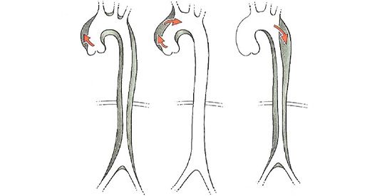 Verschiedene Formen der Dissektion: linksseitig ist die ganze Aorta bis in die Beckenschlagader betroffen, mittig die herznahe Aorta (beides lebensbedrohliche Notfälle), rechts der absteigende Anteil.