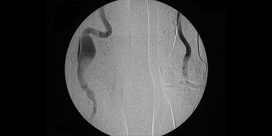 Angiographie mit Darstellung der beiden Beinschlagadern in Höhe des Kniegelenks - Aneurysma der rechten Seite.