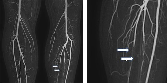 Gut sichtbare Abbrüche zweier Unterschenkelarterien des linken Beines aufgrund von Blutgerinnseln (Embolien), welche am häufigsten aus dem Herzen stammen.