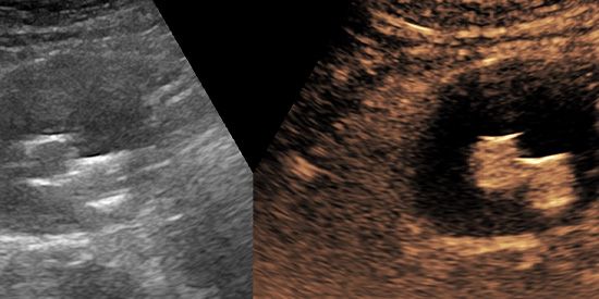 Kontrastmittelverstärkter Ultraschall mit Darstellung einer Stentprothese in einem Aneurysma. Linkes Bild: normaler Ultraschall, rechts KM verstärkt.