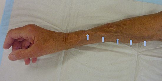Typischer Verlauf einer Unterarmvene, welche in Höhe des Handgelenks an die Arterie angeschlossen wurde und als Dialyseshunt verwendet wird.