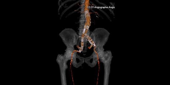 Implantierte Stentprothese mit Auskleidung eines Aorteneneurysmas sowie beidseitiger Aneurysmen der Beckenschlagadern. Die Aneurysmen sind nicht mehr dargestellt, da sie nicht mehr von Blut durchströmt sind.