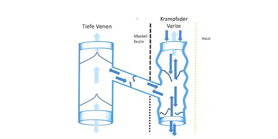 Schema des Venensystems mit defekten Venenklappen im oberflächlichen Venensystem und der Verbindungsvene. Der Klappenschaden führt zu einem ungeregelten Blutfluss und einem Stau im System.