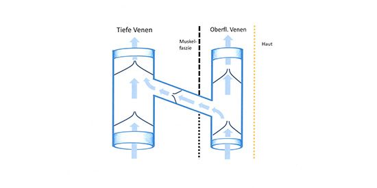 Schema des (intakten) oberflächlichen und tiefen Venensystems, einer Verbindungsvene, sowie der Venenklappen, die den Blutstrom steuern.