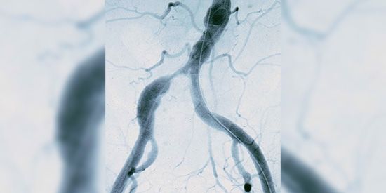 Angiographie einer hochgradigen Engstelle einer rechtsseitigen Beckenschlagader. Hierdurch entsteht eine typische Schaufensterkrankheit.