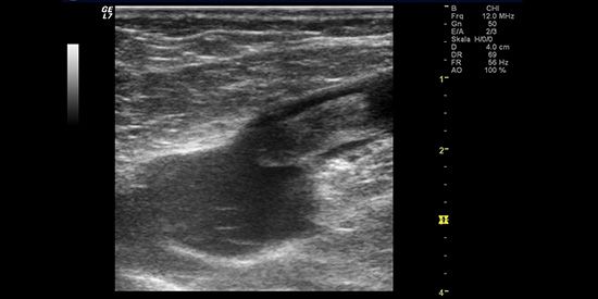 Oberflächliche Thrombose mit einem Blutgerinnsel in der Leiste.