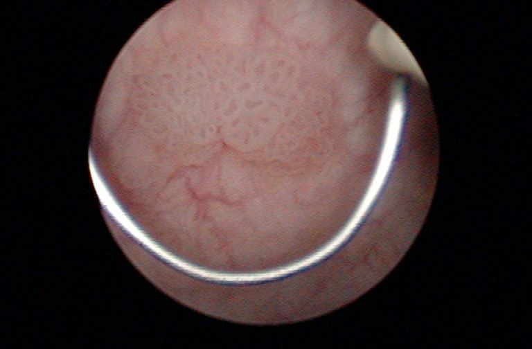 Resektionsschlinge zur Entfernung des Blasentumors 