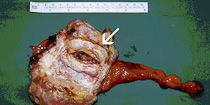 Der Hoden wurde am Samenstrang (rechts) abgesetzt. Der Hoden wurde anschl. aufgeschnitten, an der Schnittfläche zeigt sich eine unregelmäßige Tumorformation (Pfeil), die annähernd den gesamten Hoden einnimmt. Histologisch wurde ein 