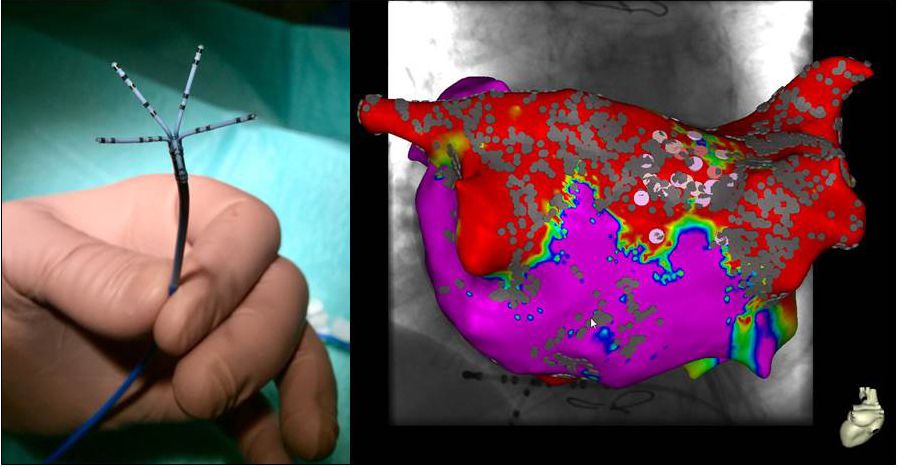 Multipolarer Mappingkatheter, hochauflösende Kartierung des linken Vorhofs